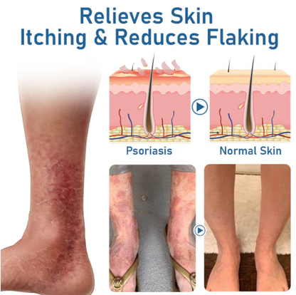 Fivfivgo™ Psoriasis Moisturizing and Soothing Cream