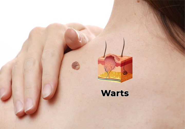 Fivfivgo® WartLift Corn Removal Liquid